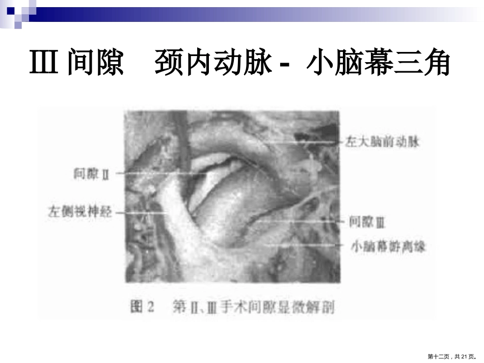 鞍区解剖间隙及临床应用PPT_第12页