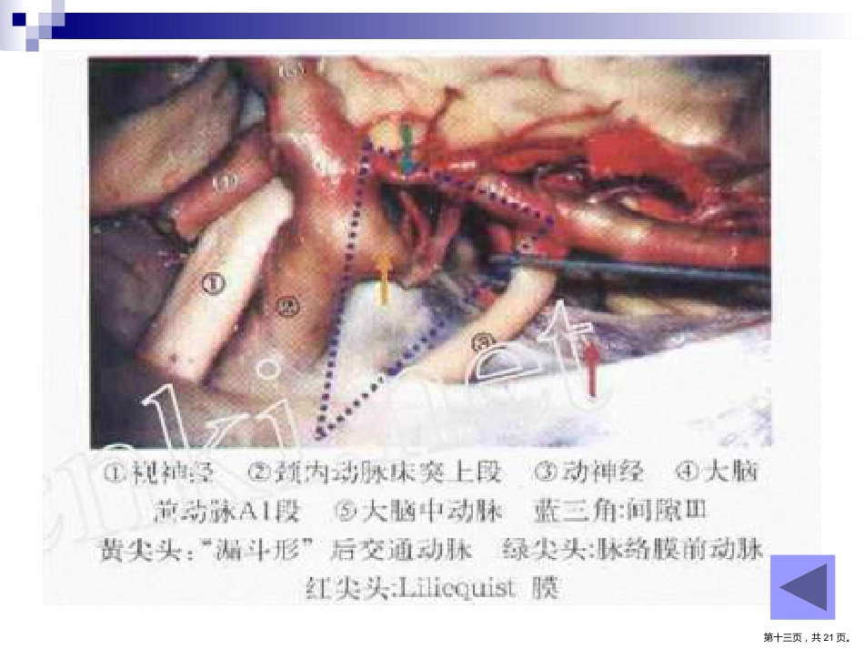 鞍区解剖间隙及临床应用PPT_第13页