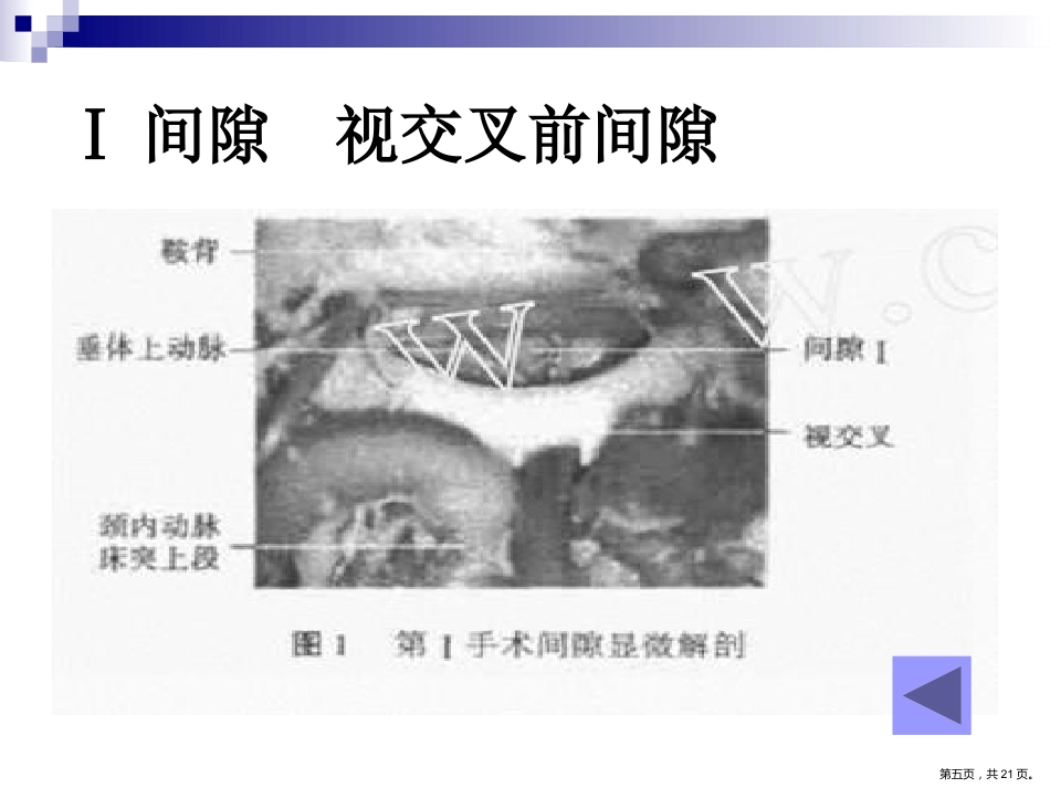 鞍区解剖间隙及临床应用PPT_第5页