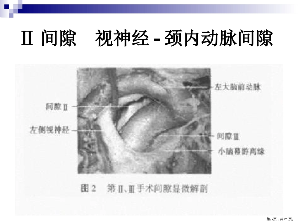 鞍区解剖间隙及临床应用PPT_第8页