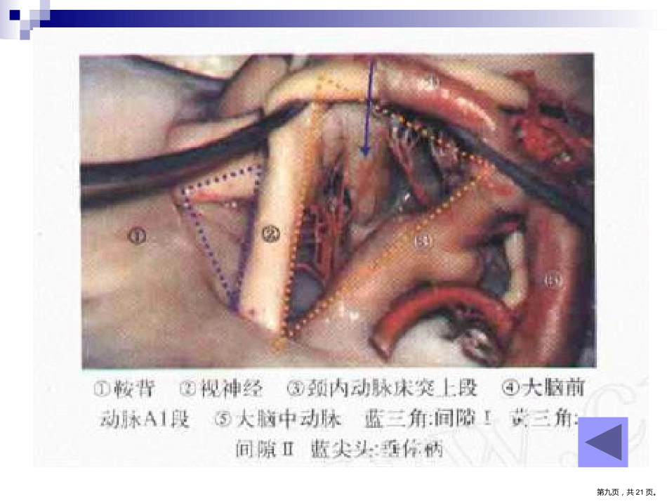 鞍区解剖间隙及临床应用PPT_第9页
