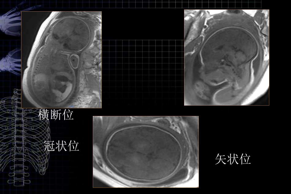 MRI对胎儿颅脑检查的作用和临床意义ppt课件_第11页