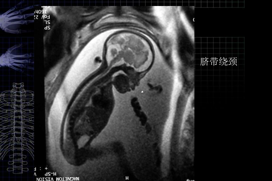 MRI对胎儿颅脑检查的作用和临床意义ppt课件_第6页