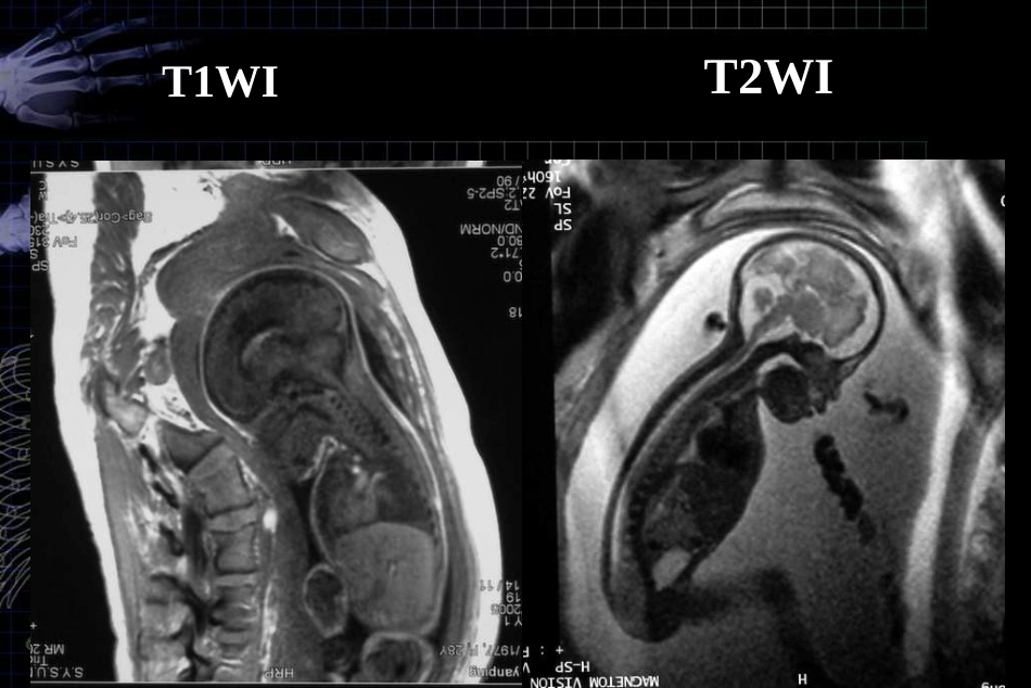 MRI对胎儿颅脑检查的作用和临床意义ppt课件_第9页
