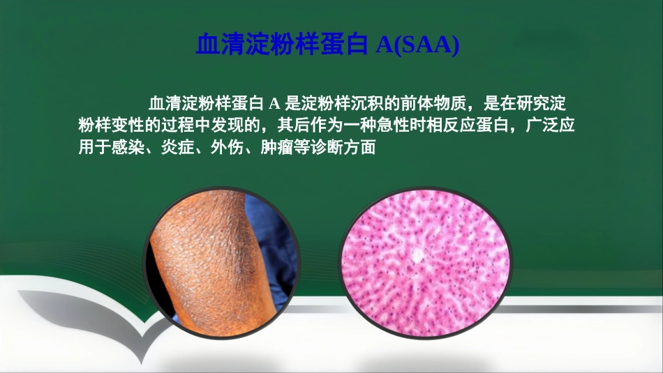 SAA联合CRP的临床诊断意义PPT讲稿_第7页