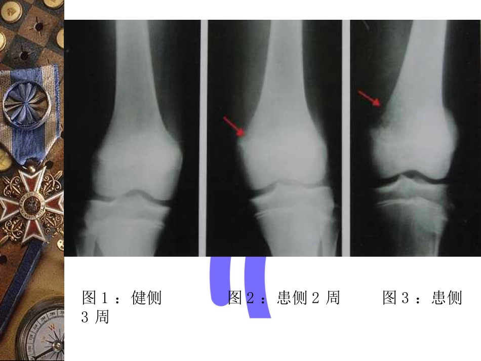 骨科-骨与关节感染_第14页