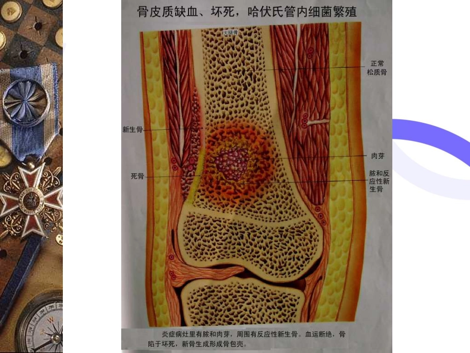 骨科-骨与关节感染_第8页
