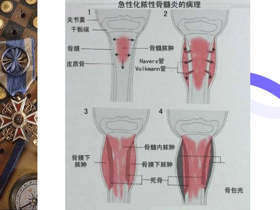 骨科-骨与关节感染_第9页