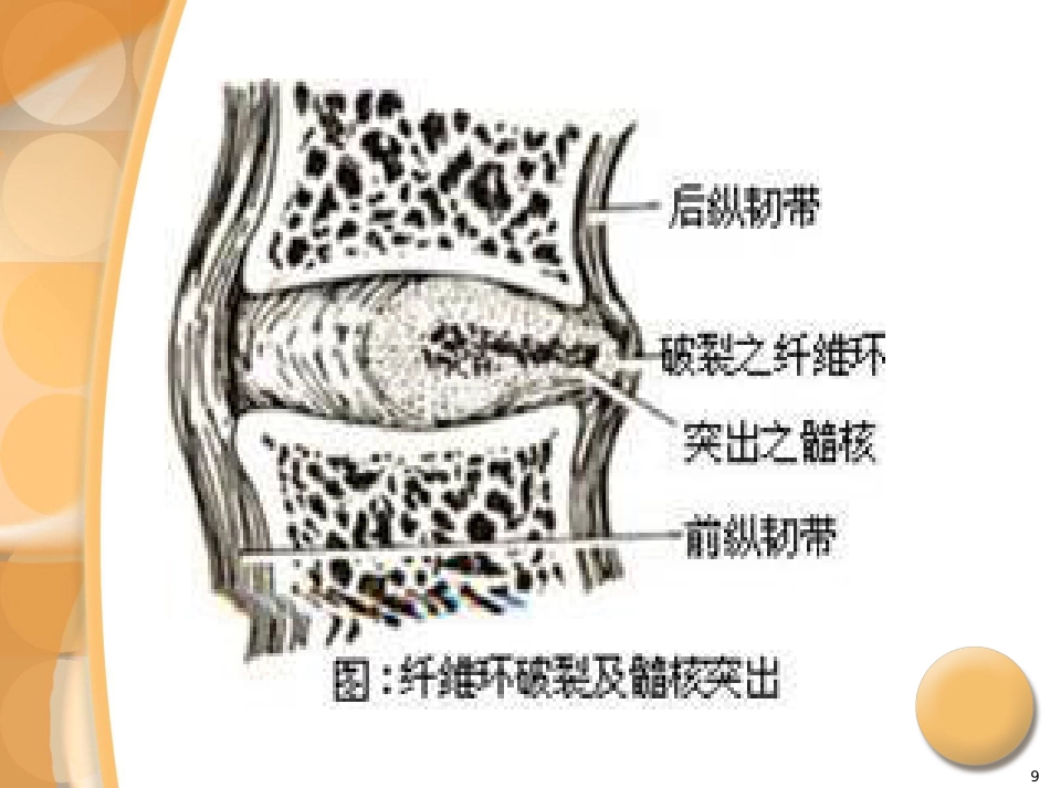骨科-腰椎间盘突出症诊治PPT课件_第9页