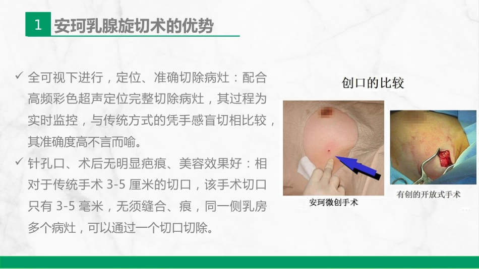 安珂乳腺旋切系统的临床应用_第11页