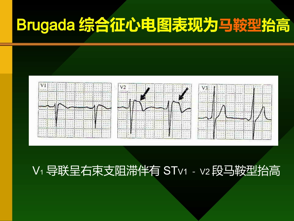 Brugada综合症的认识及其临床进展_第8页