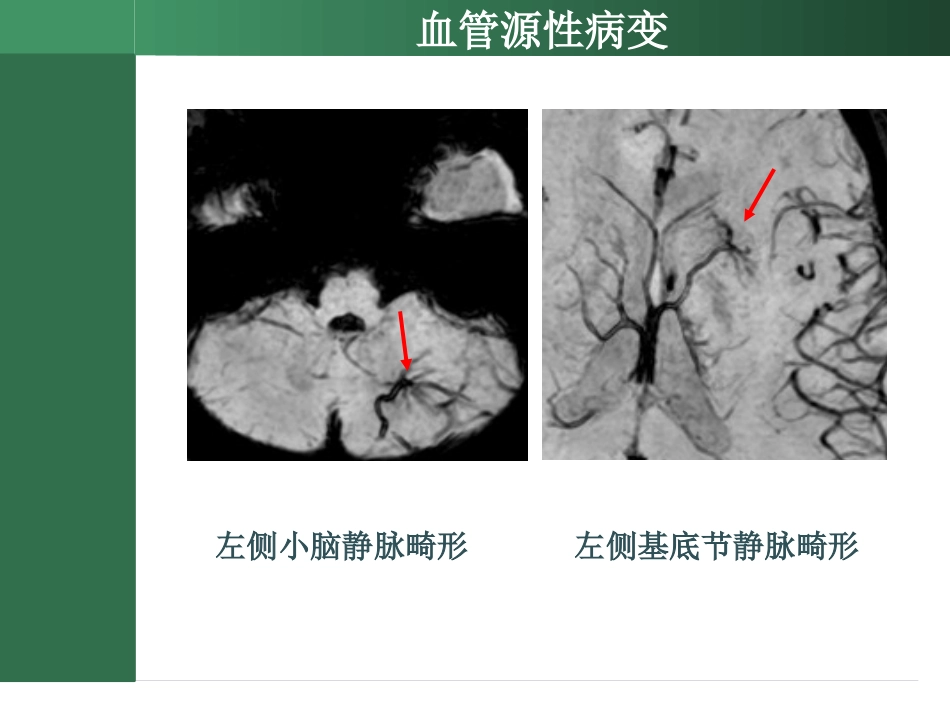 SWI的临床应用_第10页