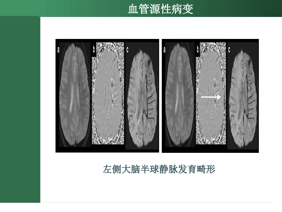 SWI的临床应用_第11页