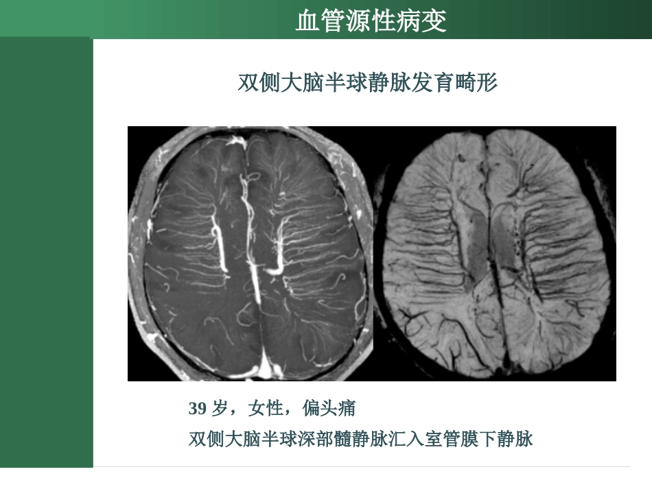 SWI的临床应用_第12页