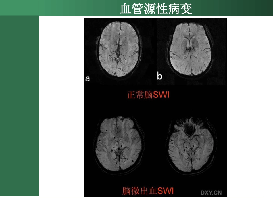 SWI的临床应用_第15页