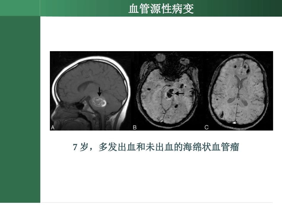 SWI的临床应用_第6页