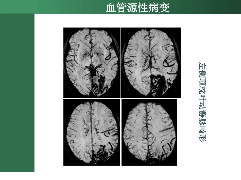SWI的临床应用_第9页