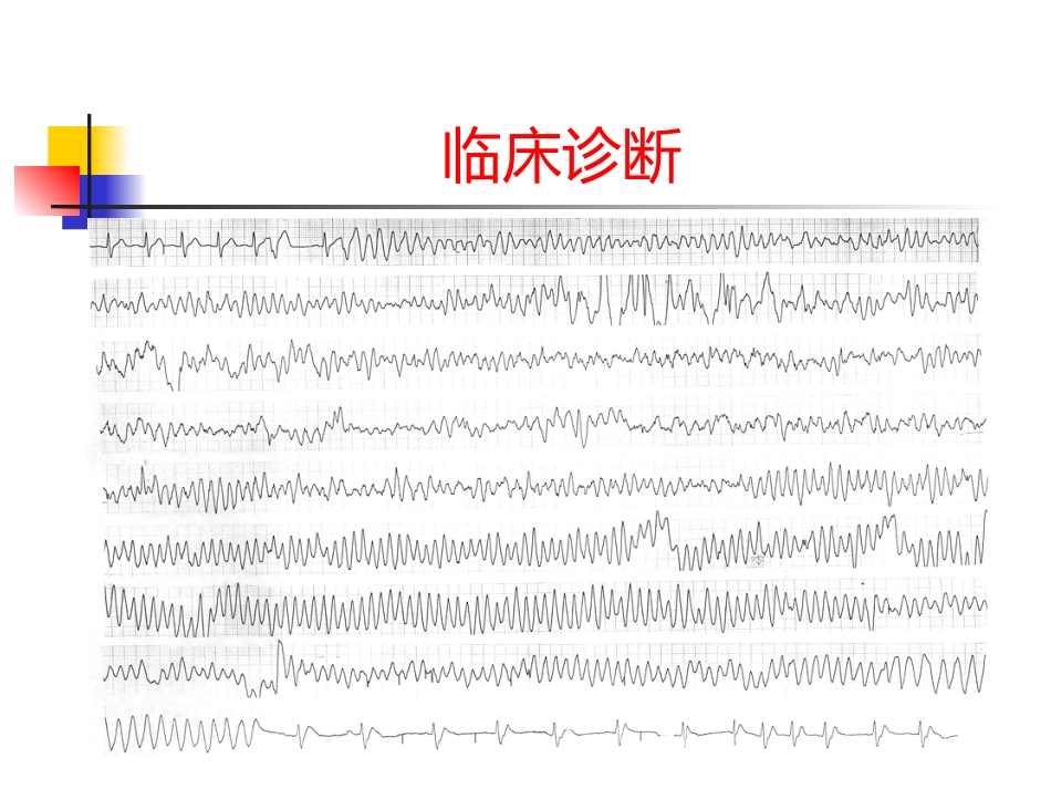 Brugada综合征的临床诊断_第10页