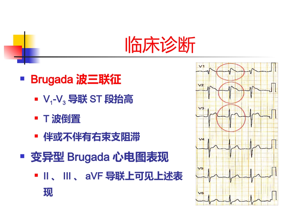 Brugada综合征的临床诊断_第15页