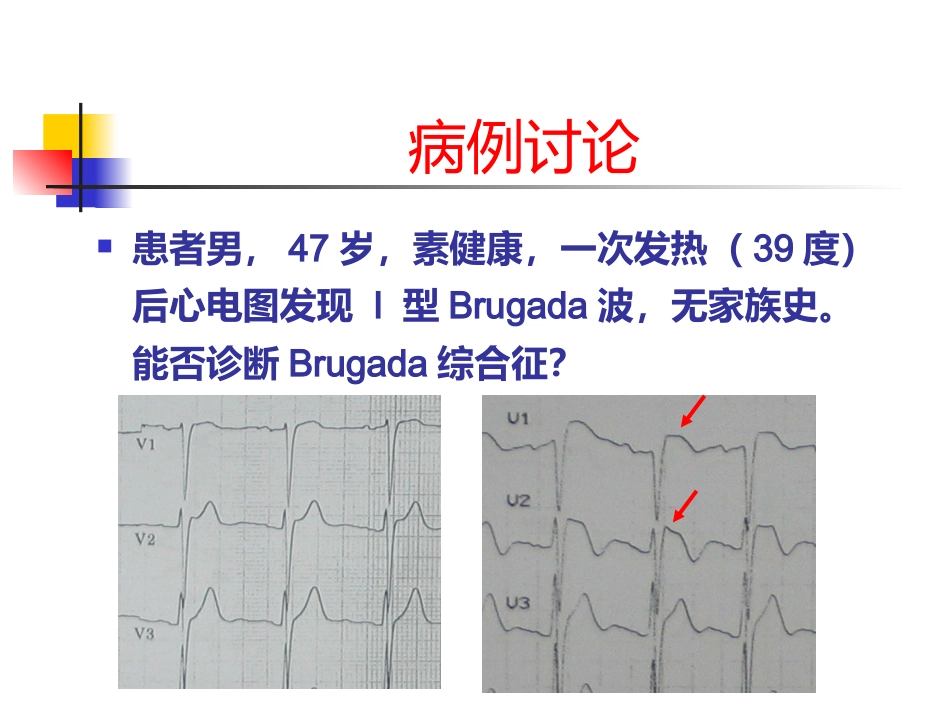 Brugada综合征的临床诊断_第3页