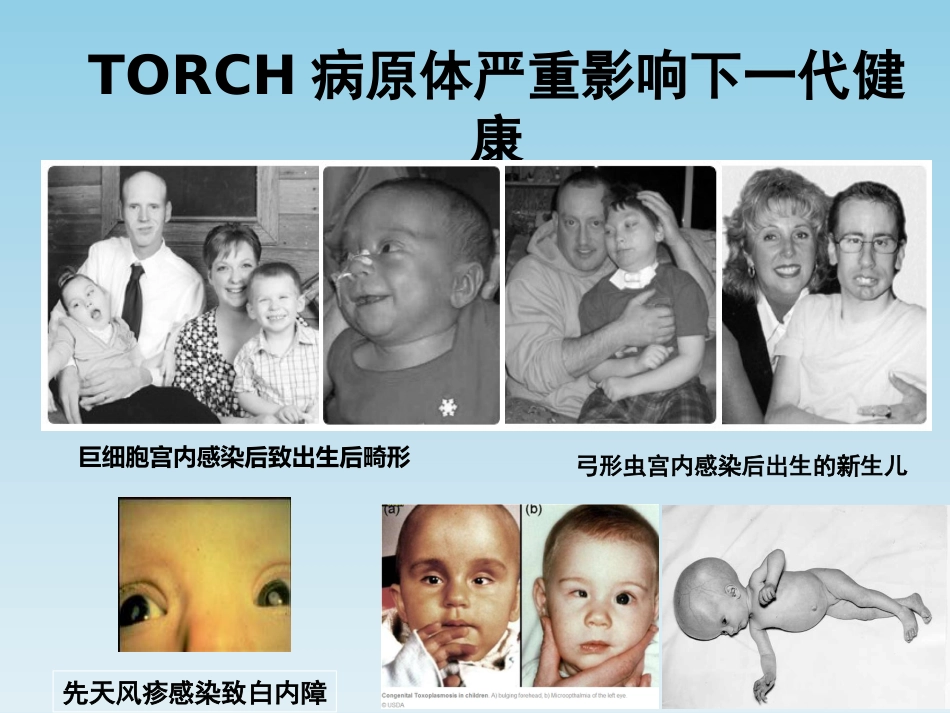 TORCH基因芯片检测及其临床意义_第5页