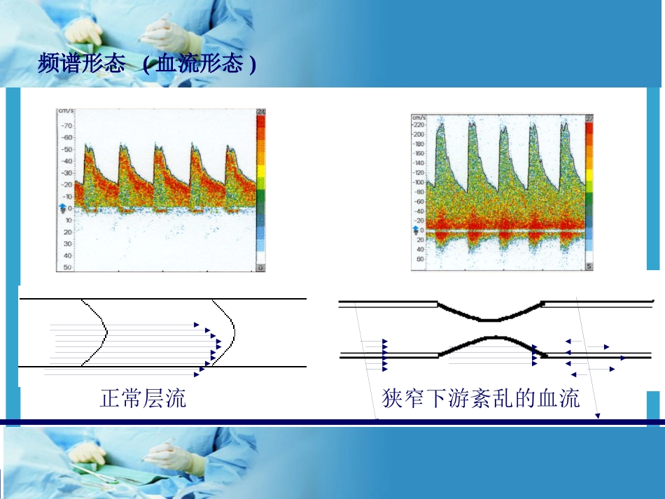 TCD的临床应用及报告解读_第12页