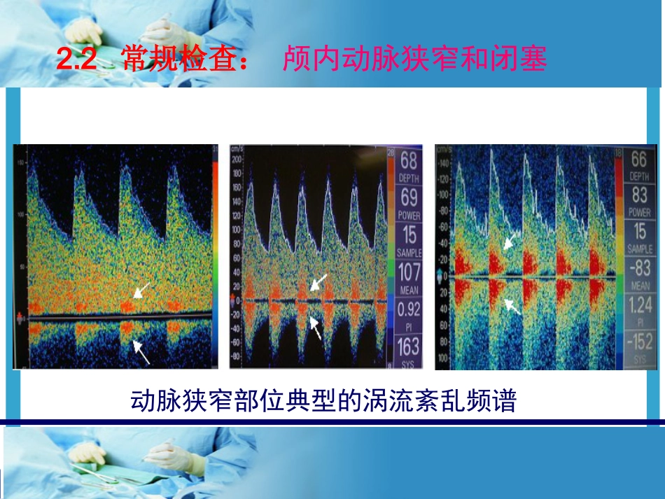 TCD的临床应用及报告解读_第13页