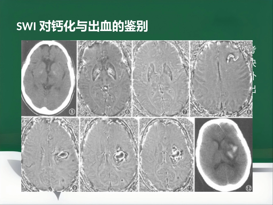 SWI的临床应用(1)_第12页