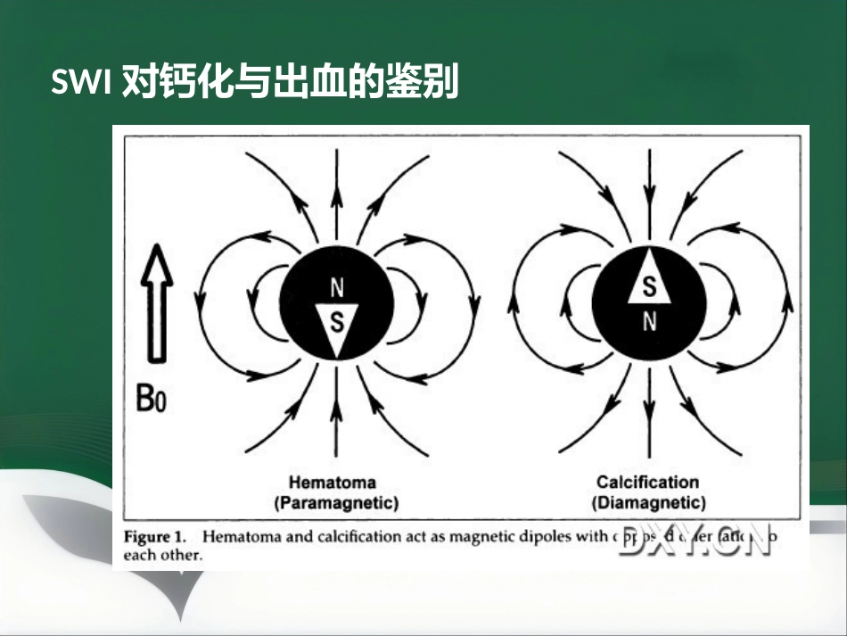 SWI的临床应用(1)_第8页