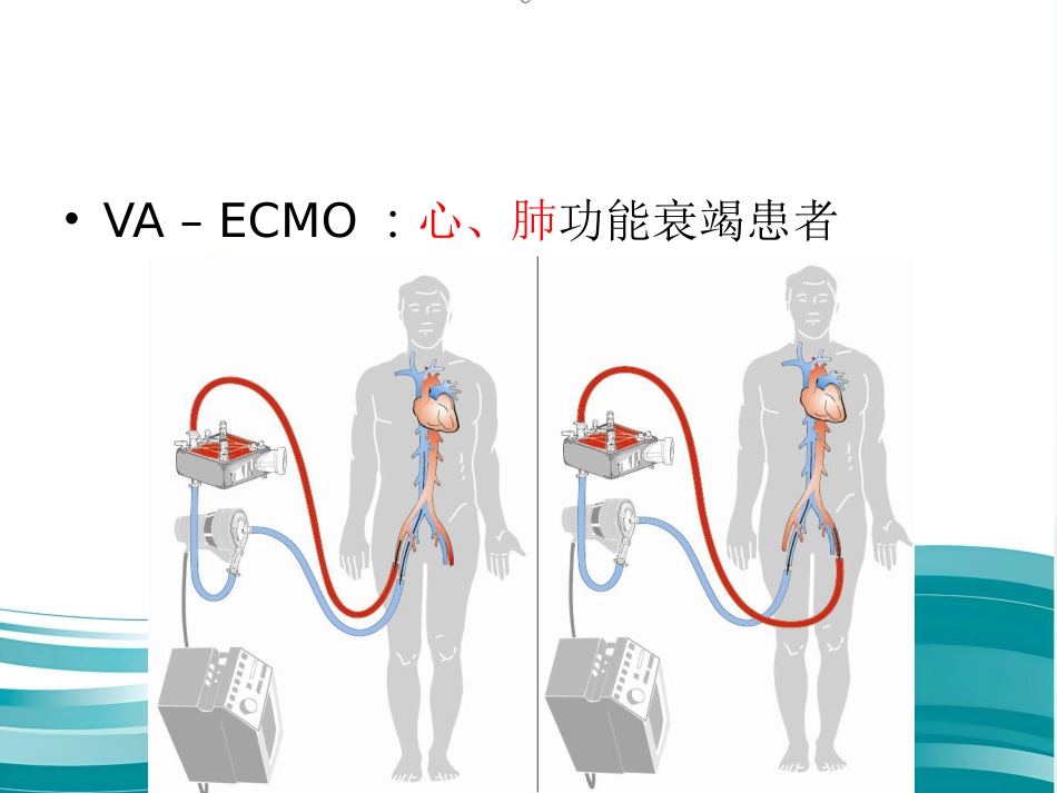 ECMO的临床应用(1)_第12页