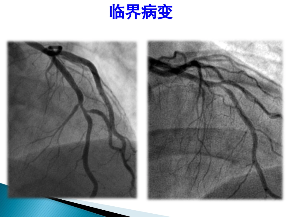 FFR 临床应用(1)_第10页