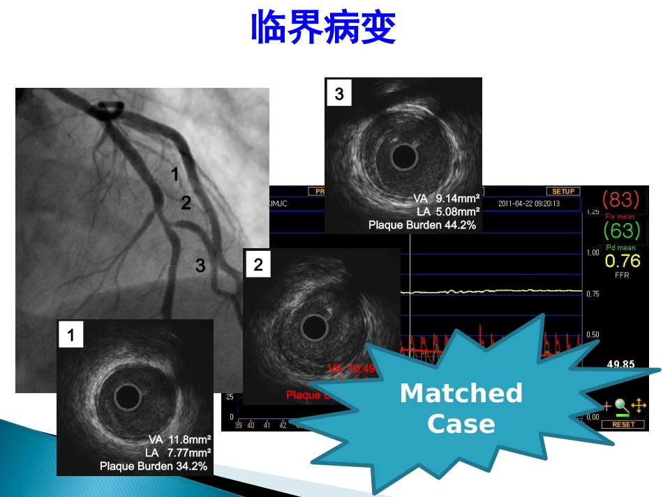 FFR 临床应用(1)_第12页