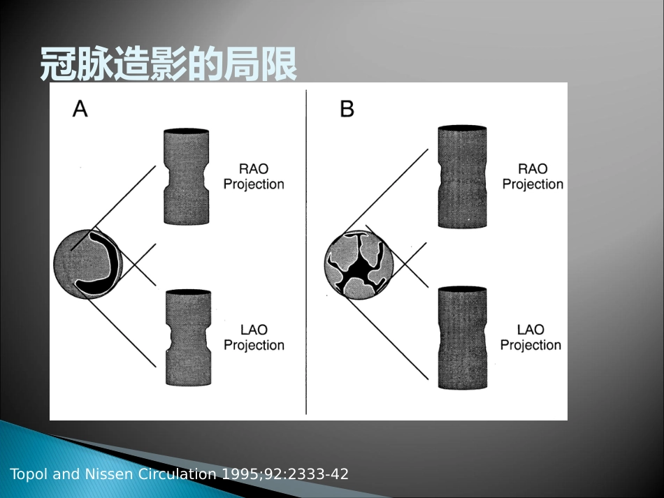 FFR 临床应用(1)_第13页