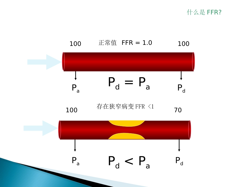 FFR 临床应用(1)_第4页