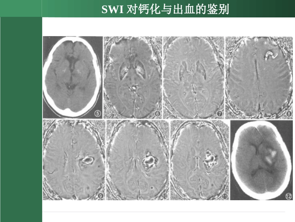 SWI的临床应用(2)_第12页