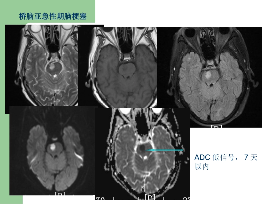15T磁共振的临床应用_第10页
