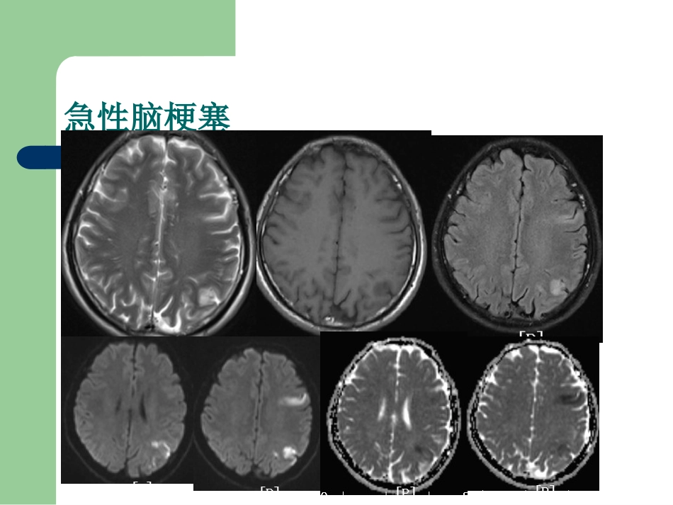 15T磁共振的临床应用_第11页
