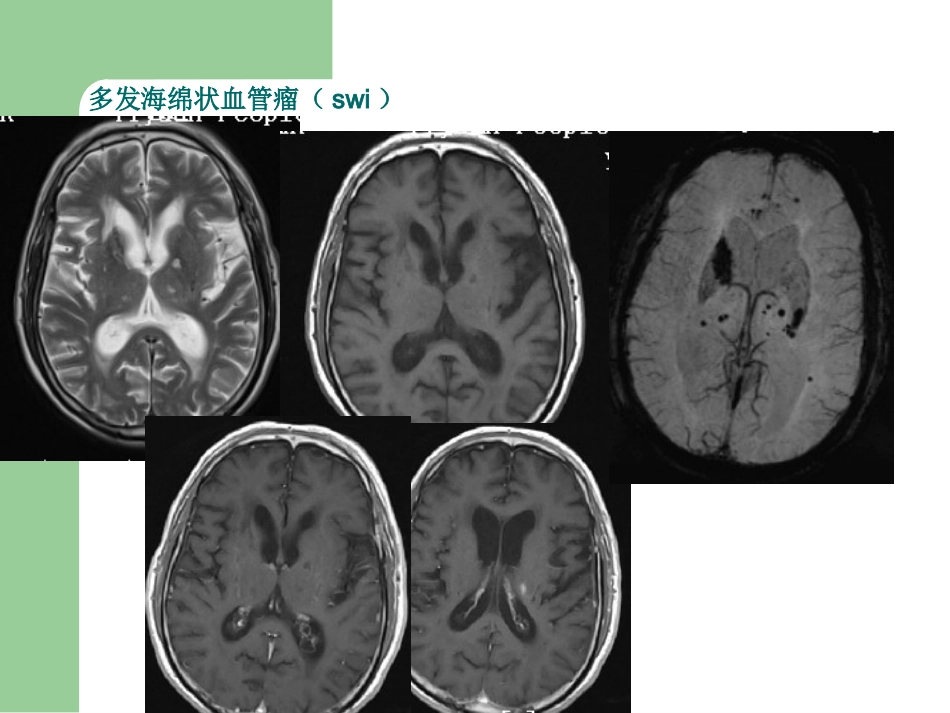 15T磁共振的临床应用_第12页