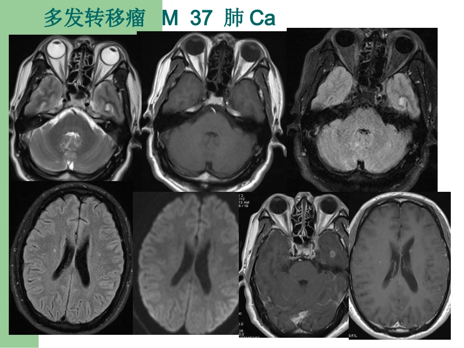 15T磁共振的临床应用_第13页