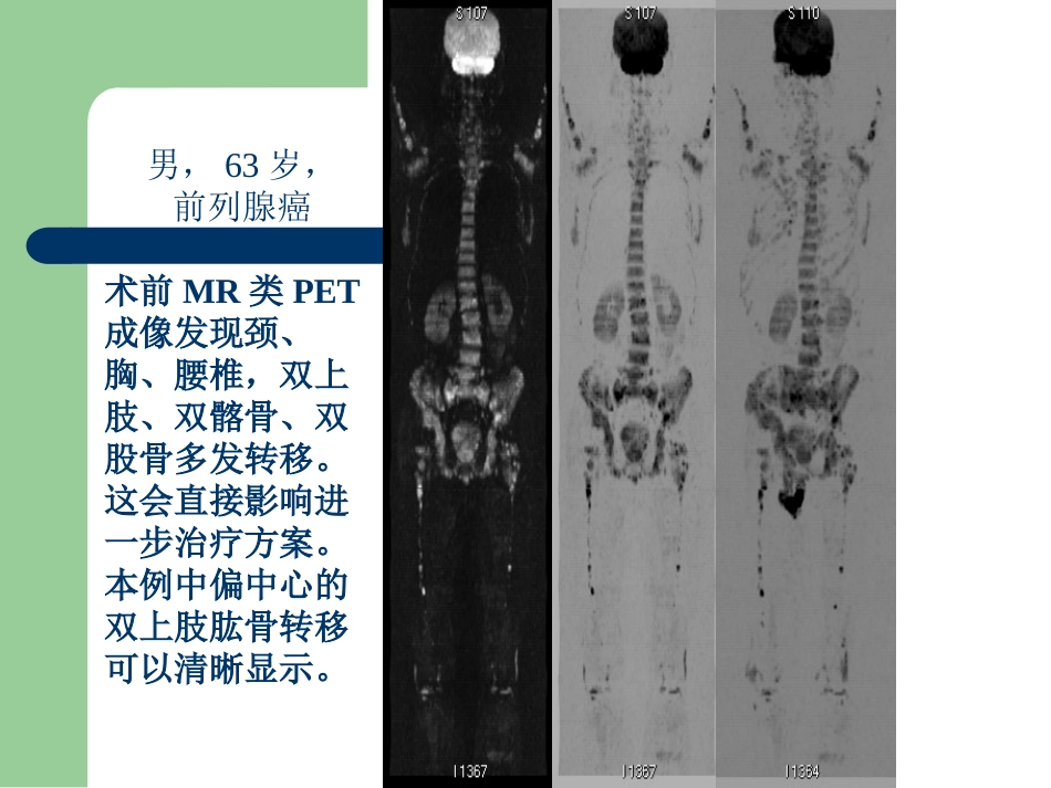 15T磁共振的临床应用_第15页