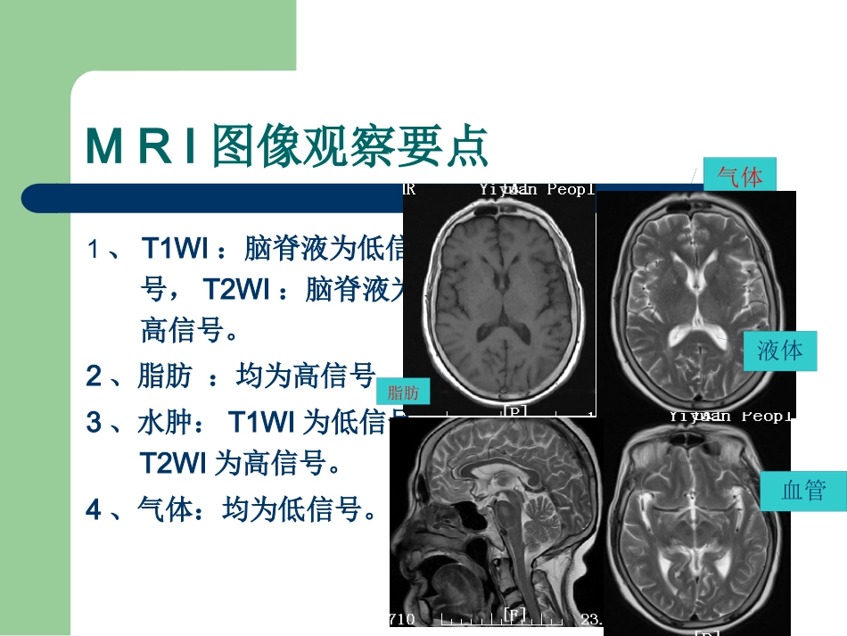 15T磁共振的临床应用_第4页