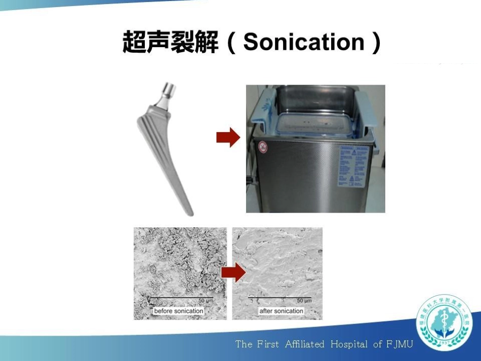 超声裂解联合 16S rRNA Real-time PCR 诊断人工关节感染_第5页