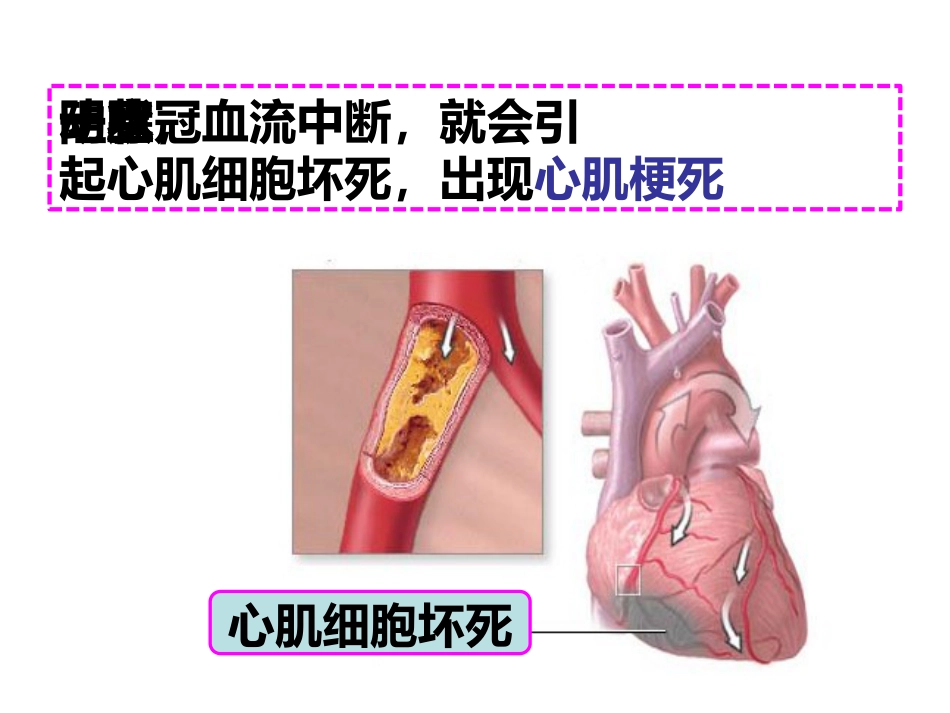呵护心肌梗死支架患者_第4页