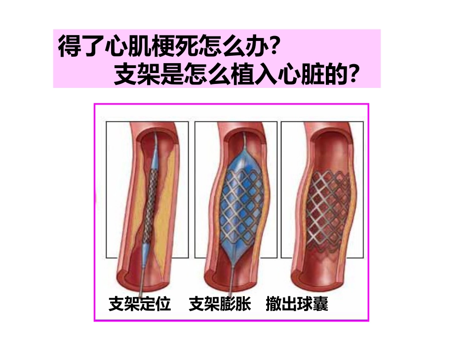 呵护心肌梗死支架患者_第6页