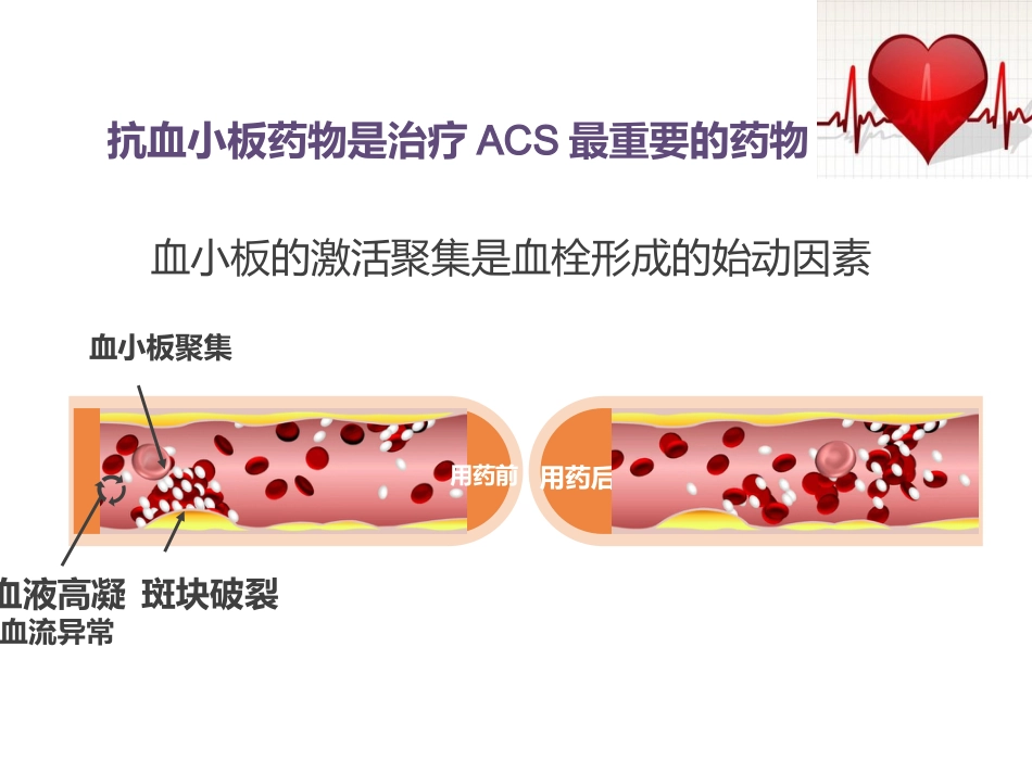 急性冠脉综合征患者健康教育_第15页