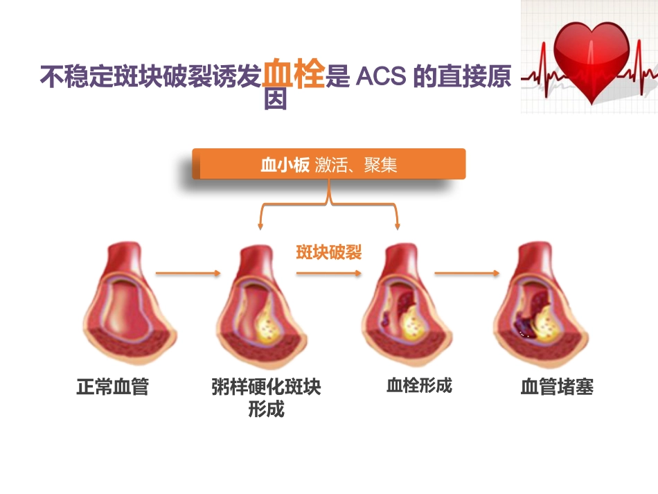 急性冠脉综合征患者健康教育_第8页