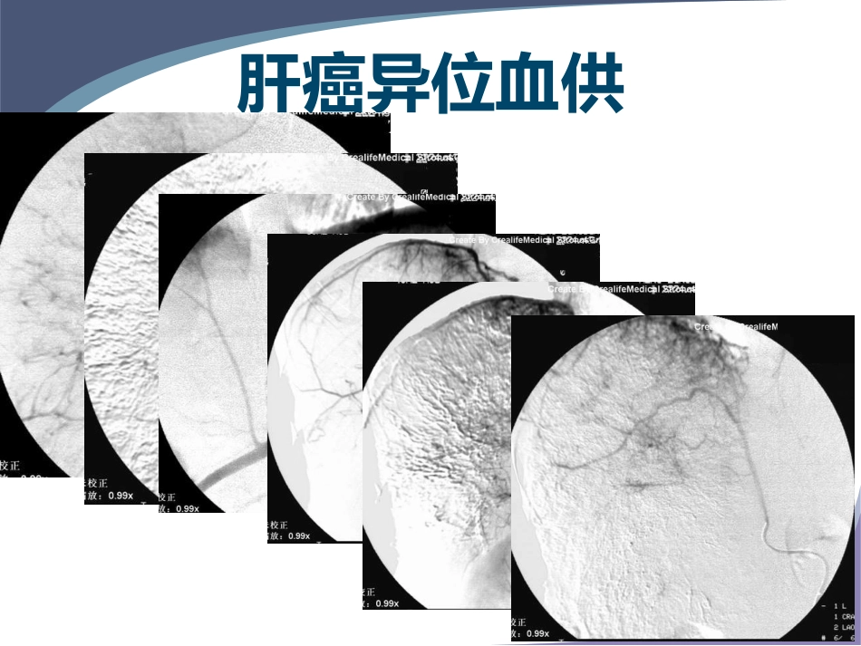 肝癌规范化介入治疗_第9页