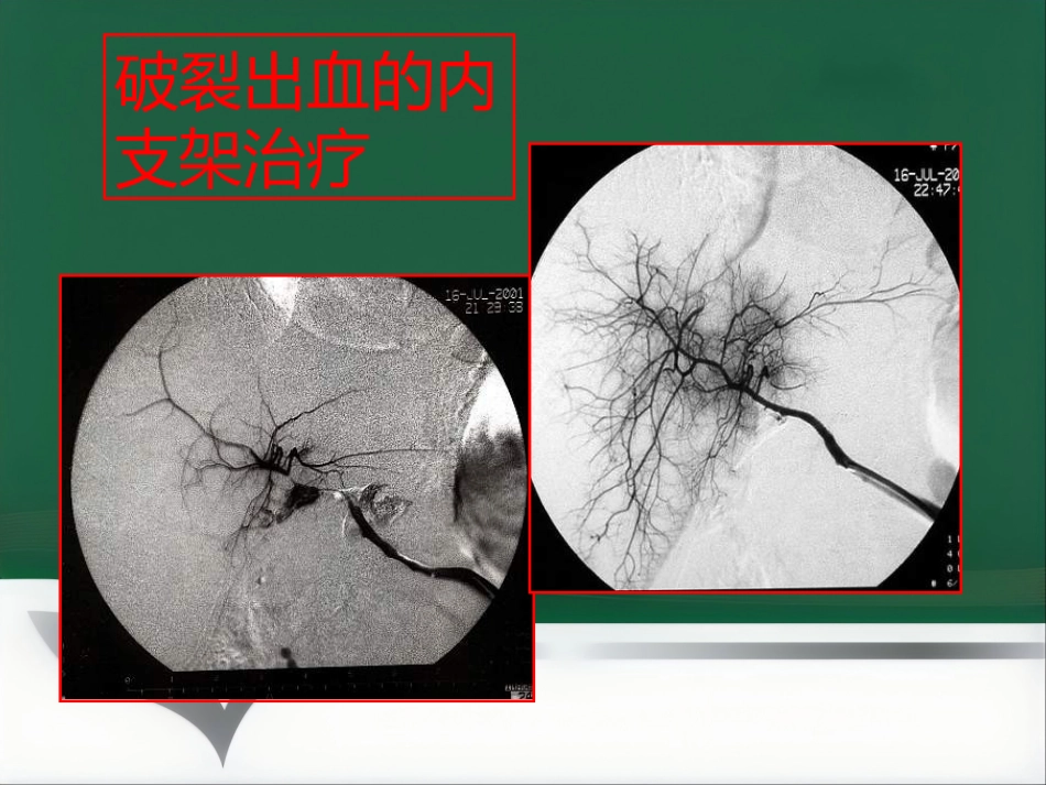 肝移植术后血管并发症的介入治疗_第14页