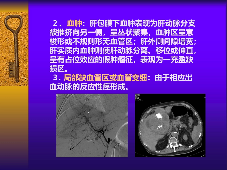 肝癌自发性破裂出血介入诊疗_第10页