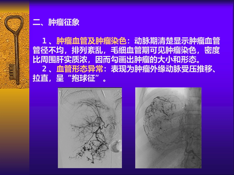 肝癌自发性破裂出血介入诊疗_第11页